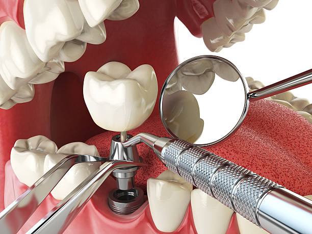 Best Emergency Dentist for Lost Fillings or Crowns in South Henderson, NC